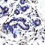 Anti-LAT-1 normal breast tissue (above). Anti-LAT-1 Primary breast tumor (below) Images from the laboratory of Hyunsuk Shim, PhD, Winship Cancer Institute at Emory University